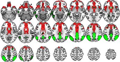 Neural basis of visuospatial tests in behavioral variant frontotemporal dementia